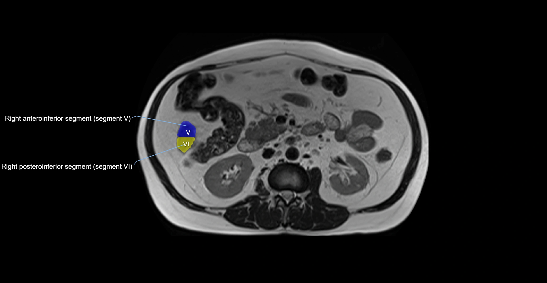 MRI  liver segments anatomy axial cross sectional 3T radiology  image-img-00001-00023.webp